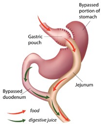 Diagram of gastric bypass surgery.
