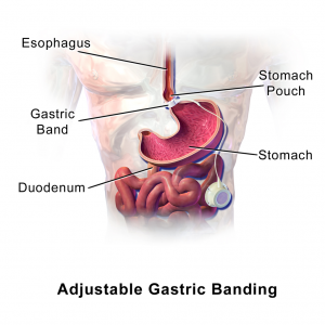 During this surgery for weight loss (LAGB), an adjustable band is placed near the top of the stomach.