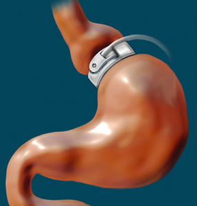 Lap band placement during bariatric surgery.