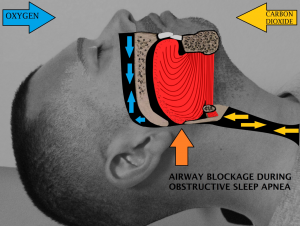 Bariatric surgery can help resolve blockage that causes obstructive sleep apnea.